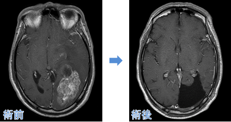 腫瘍摘出術