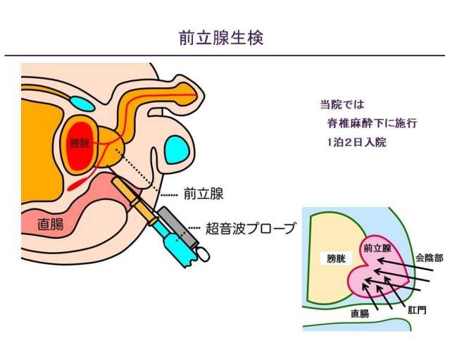 >前立腺生検