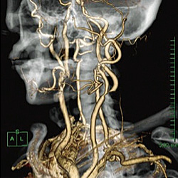 頸部CTA