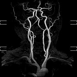 頚部MRA