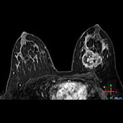 乳腺MRI